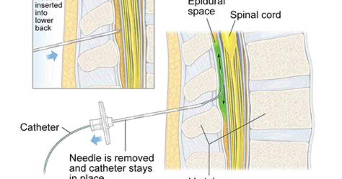 Is a Spinal Tap Like an Epidural?