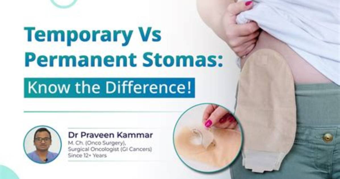 Is a Stoma Permanent