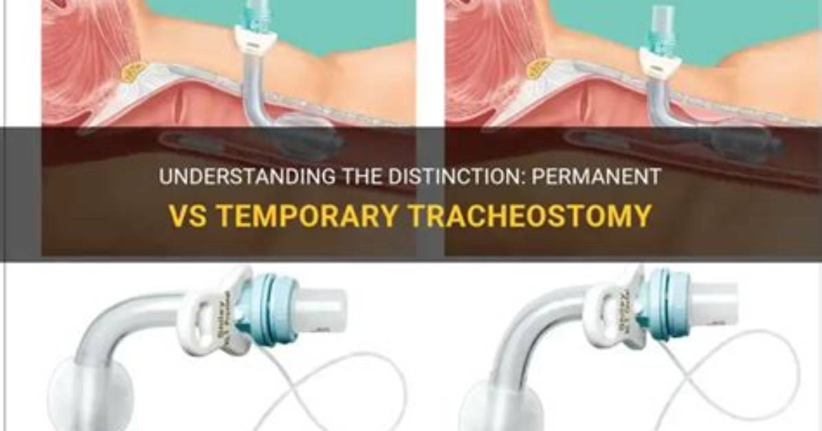Is a Tracheostomy Permanent or Temporary?
