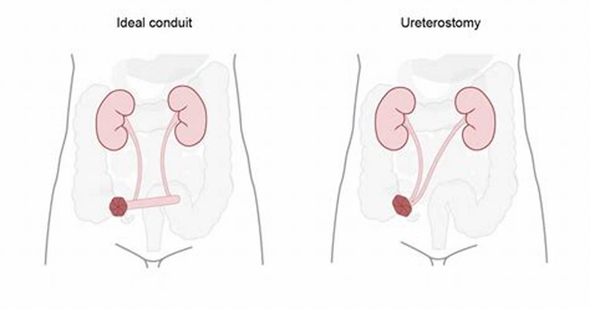 Is a Ureterostomy Permanent?