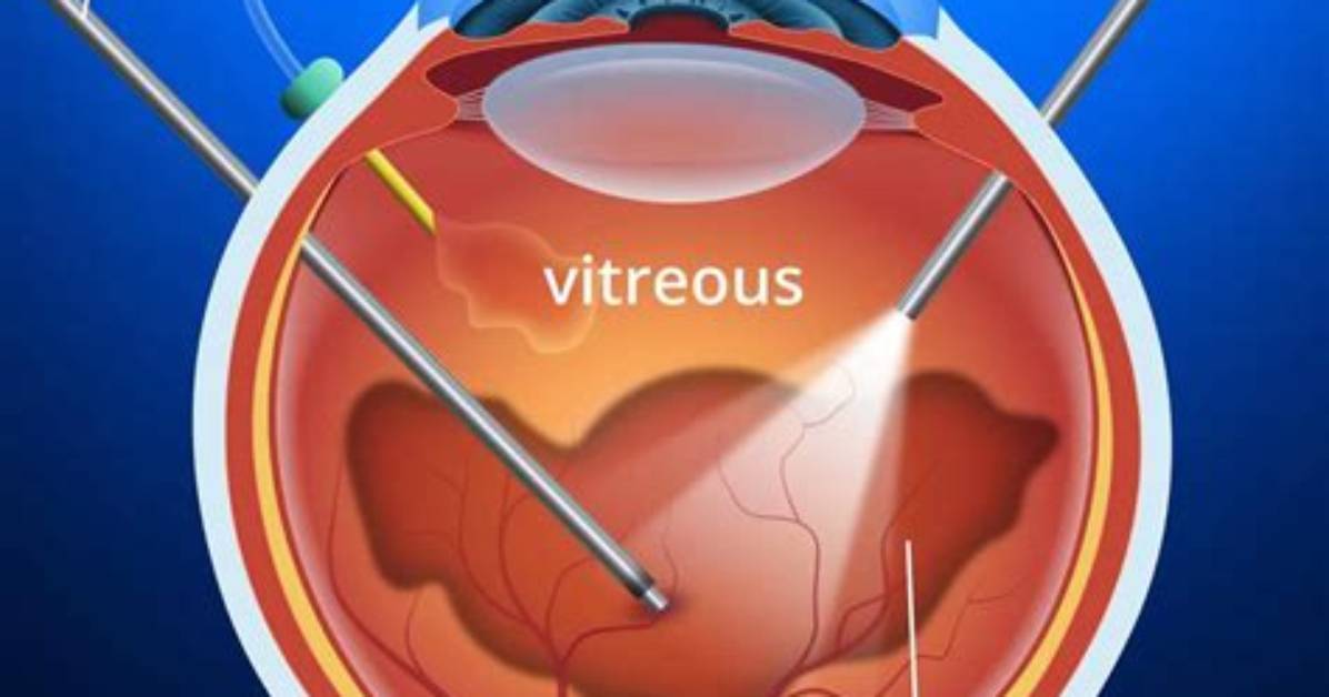 Is a Vitrectomy Painful