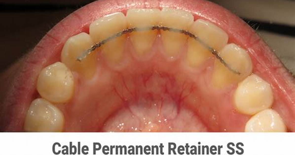 Is a Waterpik Good for Permanent Retainer?