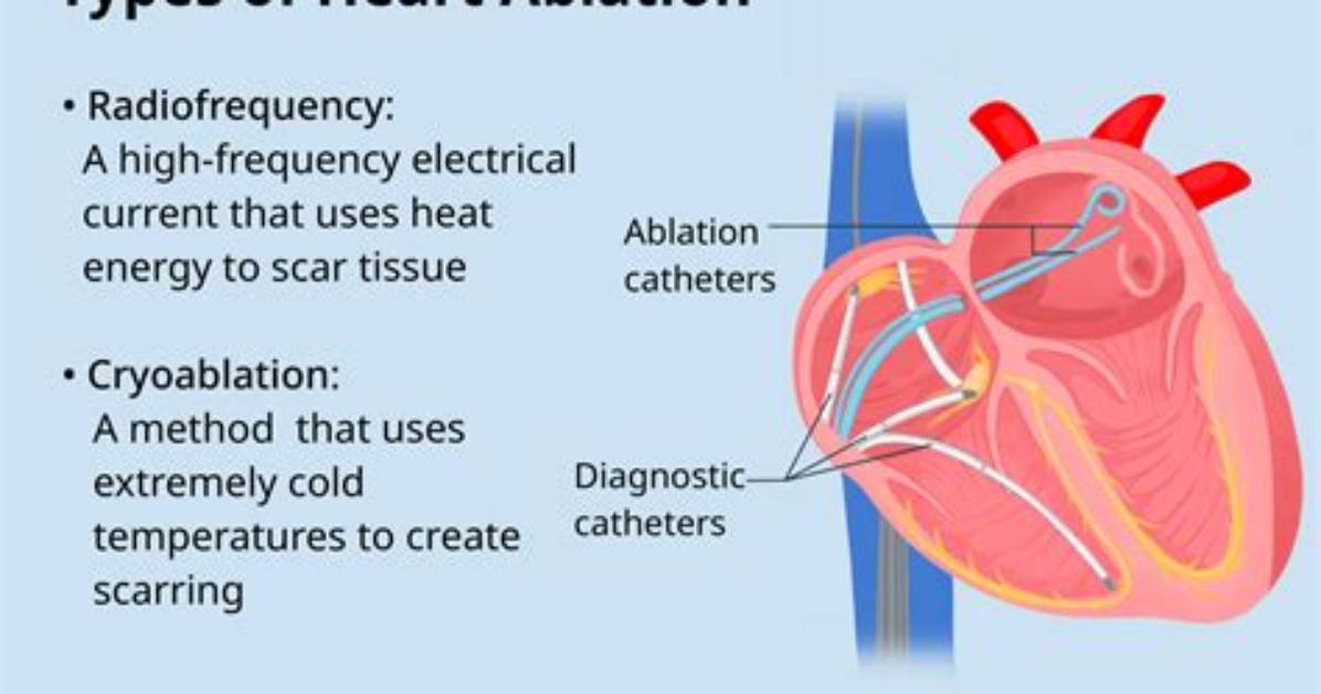 Is Ablation a Noun?
