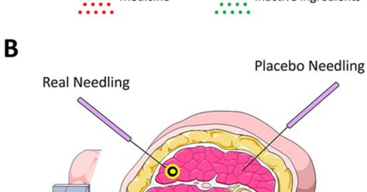 Is Acupuncture a Placebo Effect
