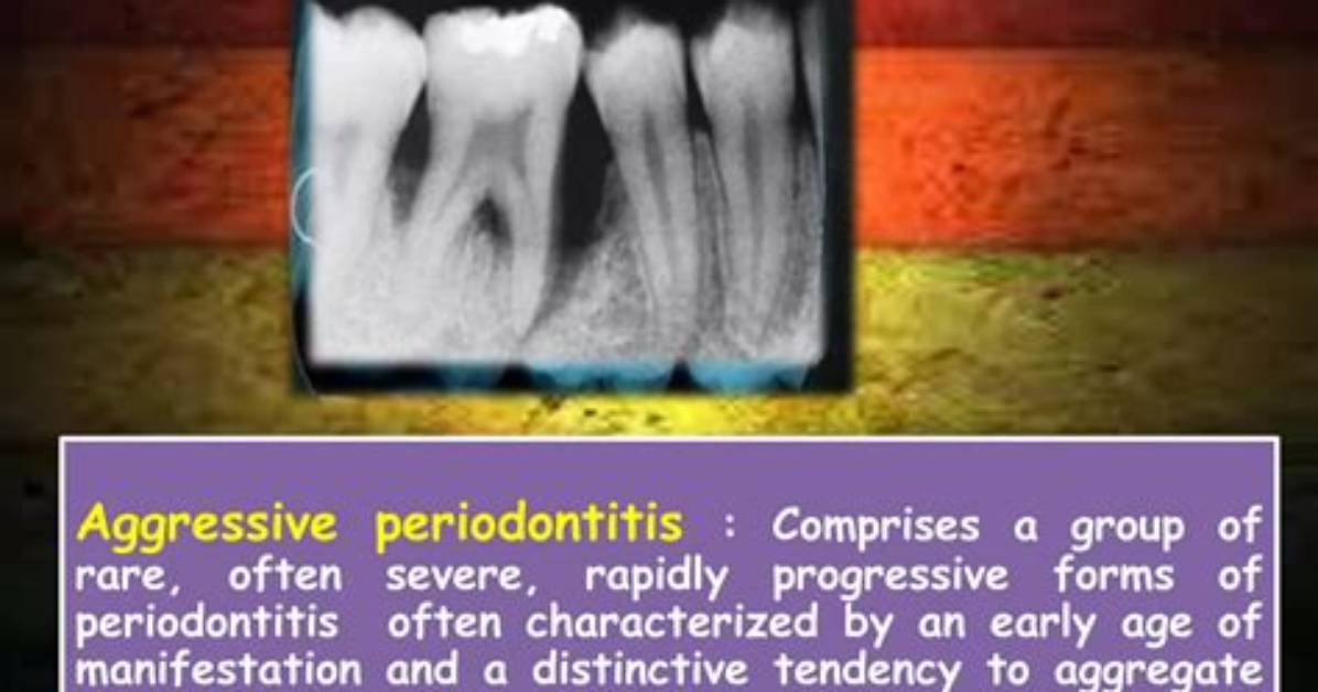 Is Aggressive Periodontitis Contagious