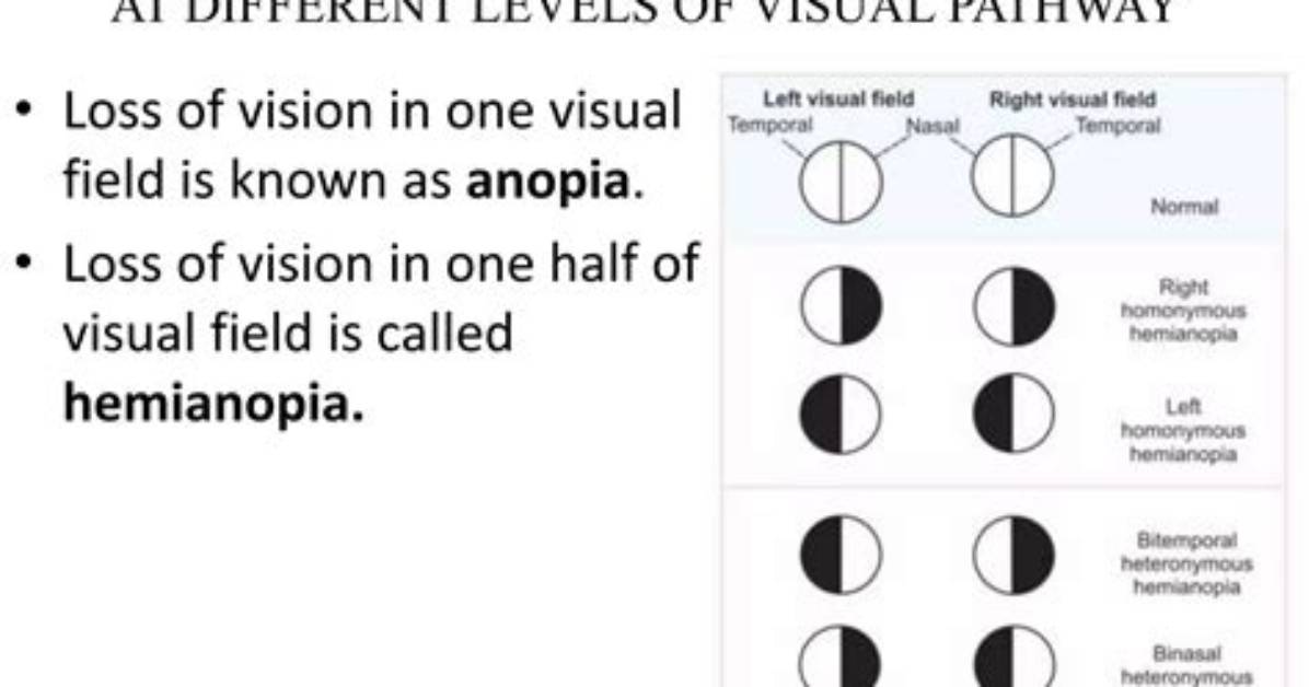 Is Anopia a Word?