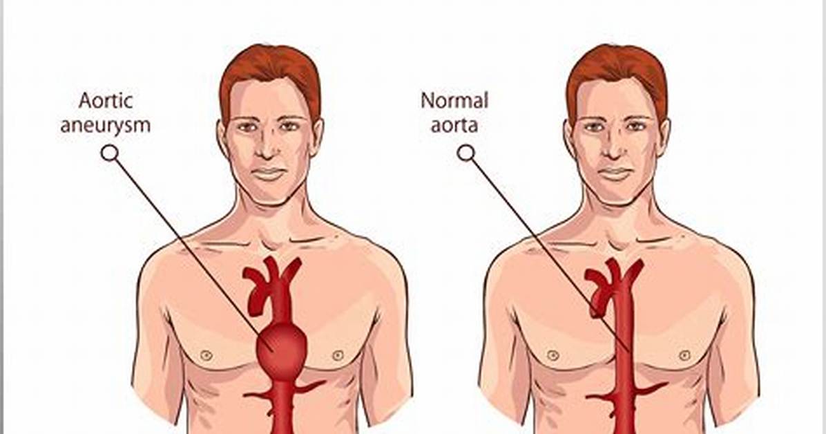 Is Aortic Aneurysm Hereditary?
