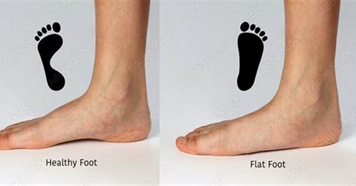 Is Being Flat Footed Genetic?
