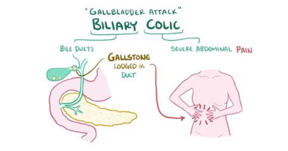 Is Biliary Colic the Same as Cholelithiasis