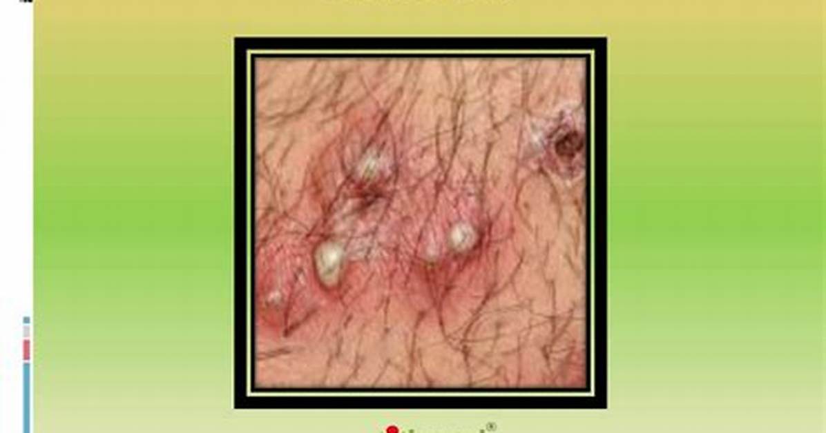 Is Chancroid a Std?