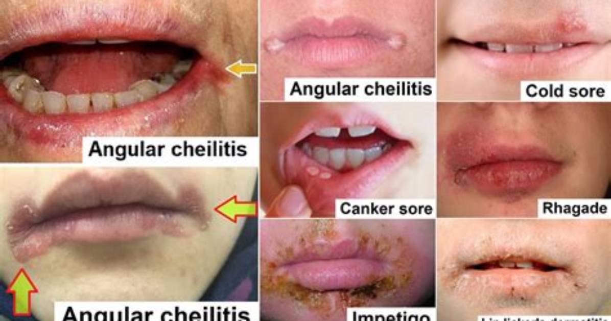 Is Cheilitis Infectious