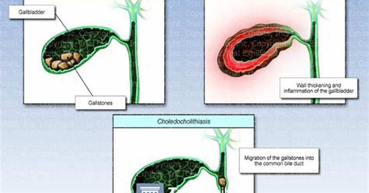 Is Choledocholithiasis the Same as Cholelithiasis?