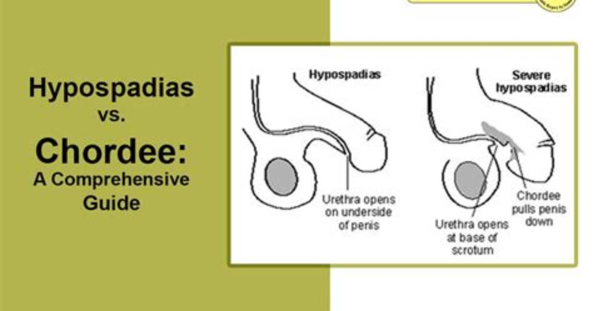 Is Chordee Surgery Necessary?