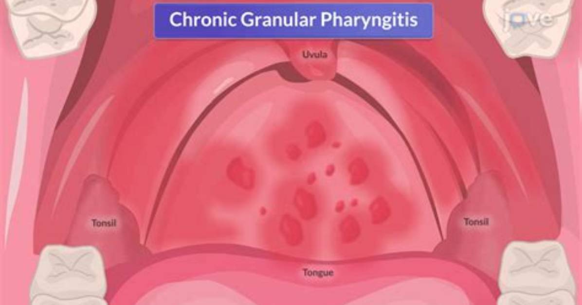 Is Chronic Pharyngitis Curable?