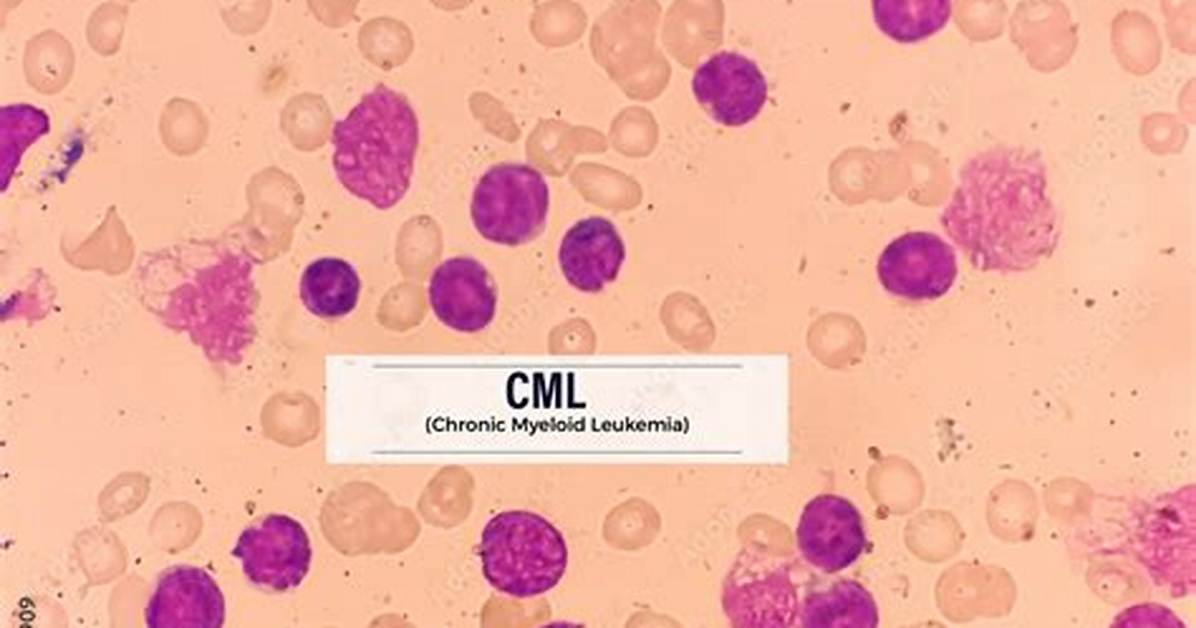 Is Cml a Cancer? | Contextresponse. Com