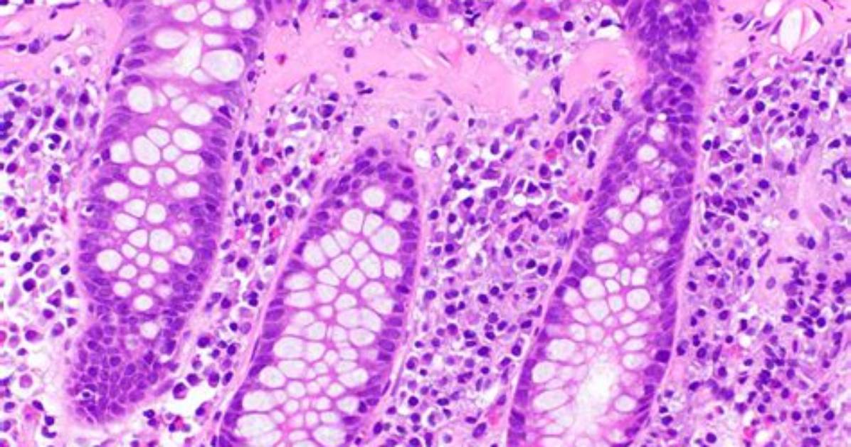 Is Collagenous Colitis Serious?