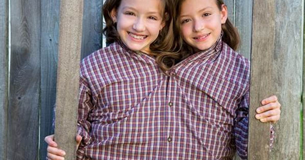 Is Conjoined Twins Real?