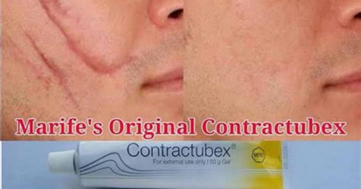 Is Contractubex Effective for Keloid?