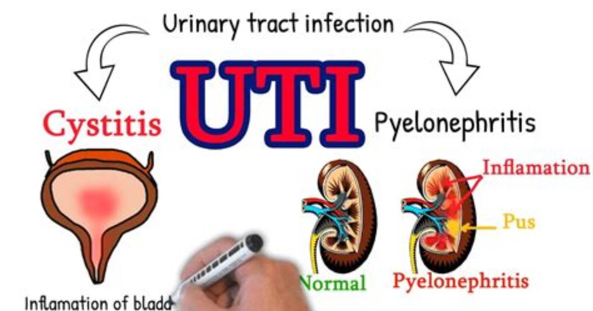 Is Cystitis the Same as Uti?