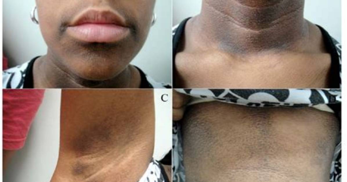 Is Dark Neck Curable?