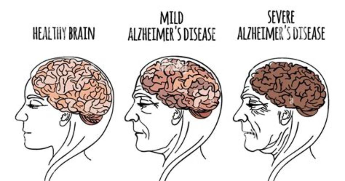 Is Dementia or a Brain Tumor to Blame for Tucker & Ashley’s Clash?