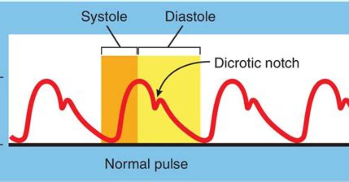 Is Dicrotic Notch Normal