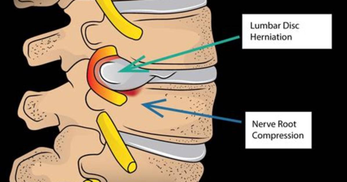 Is Disc Herniation Curable?