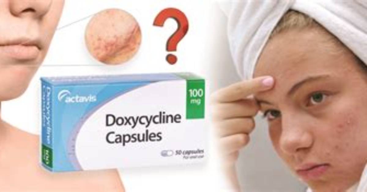Is Doxycycline for Acne?