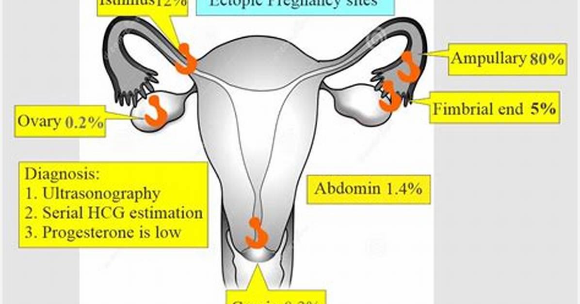 Is Ectopic Pregnancies Common?