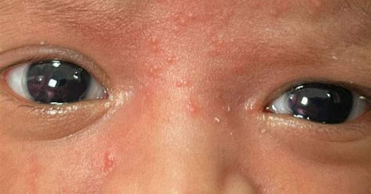 Is Erythema Toxicum Normal?