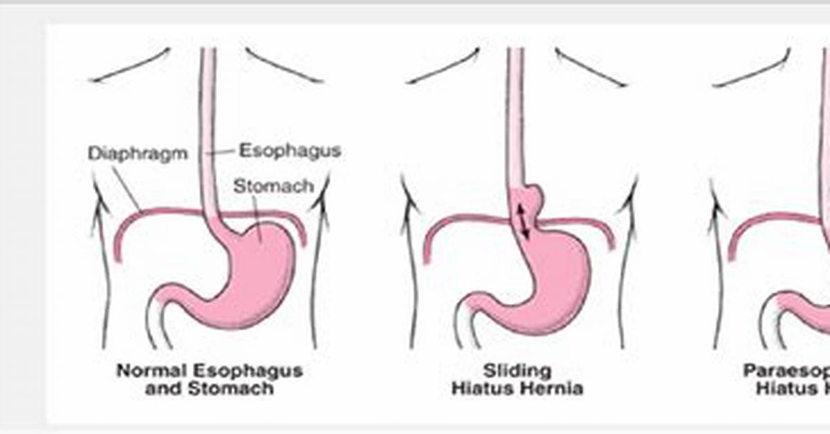 Is Eventration the Same as Hernia?