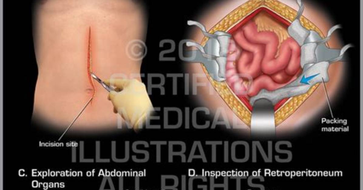 Is Exploratory Laparotomy a Major Surgery?