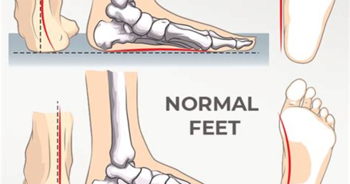 Is Flat-Footed a Disability?