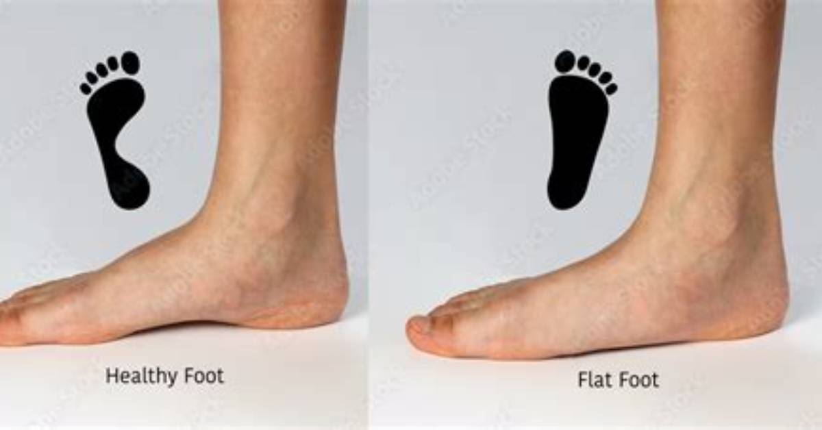 Is Flat Footed Genetic?