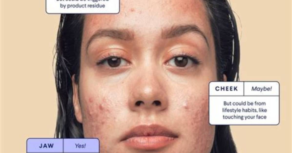 Is Forehead Acne Hormonal?