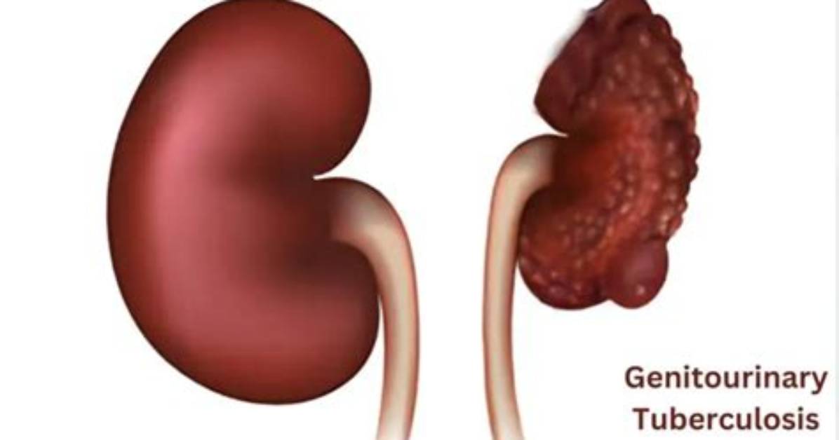 Is Genitourinary Tuberculosis Contagious?