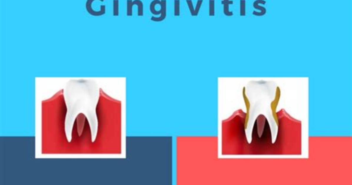 Is Gingivitis Reversible?