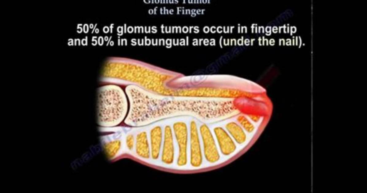 Is Glomus Tumor Curable