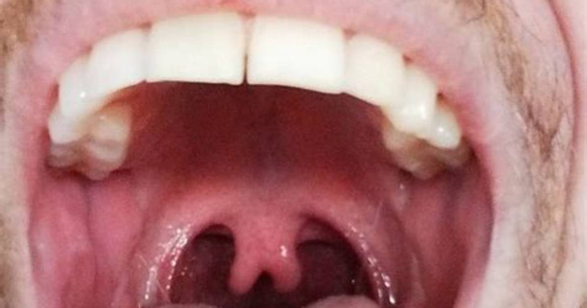 Is Having Two Uvulas Normal?