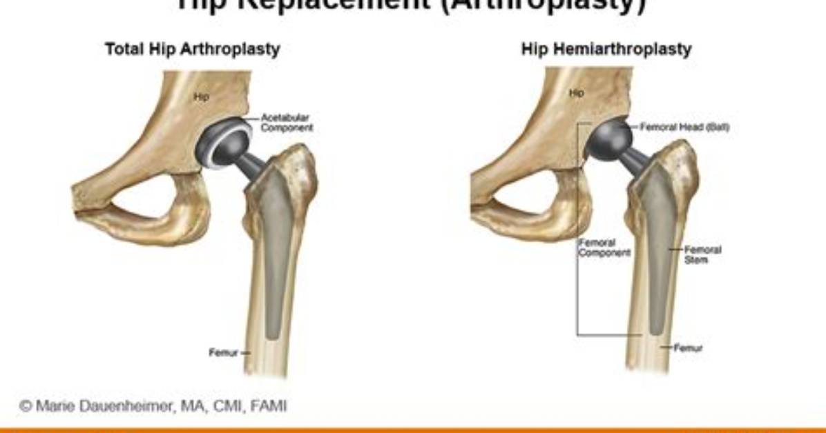 Is Hemiarthroplasty Same as Hip Replacement?