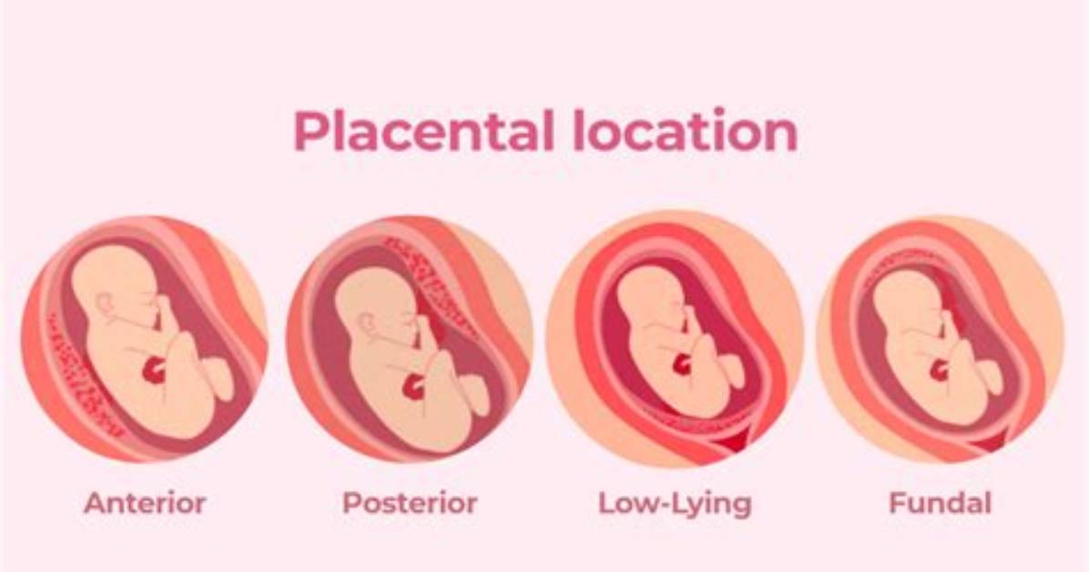 Is High Lying Placenta Normal?