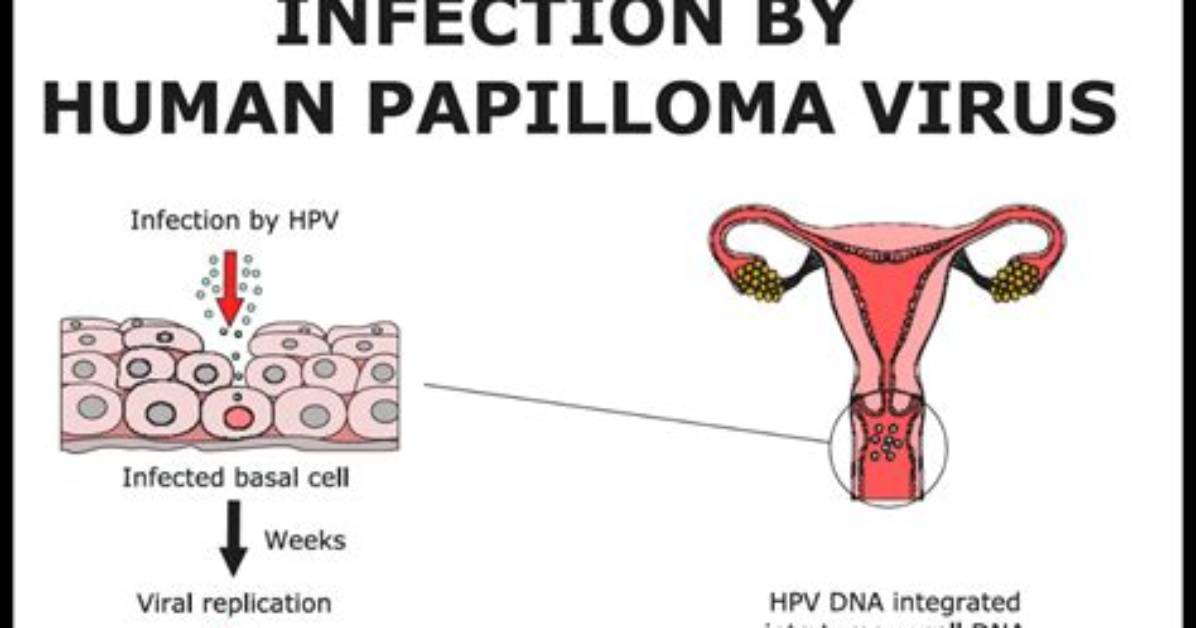 Is Hpv an Std