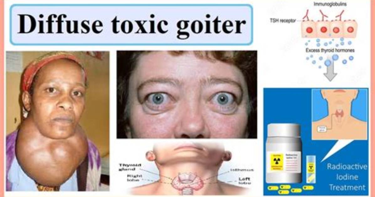 Is Hyperthyroidism and Toxic Goiter the Same