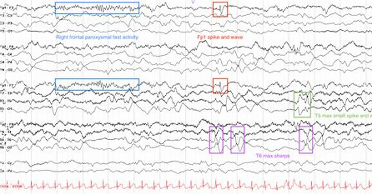 Is Interictal Epileptiform Activity?