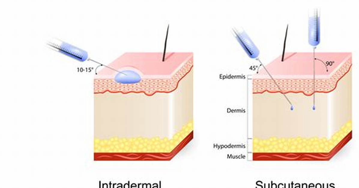 Is Intradermal the Same as Subcutaneous?