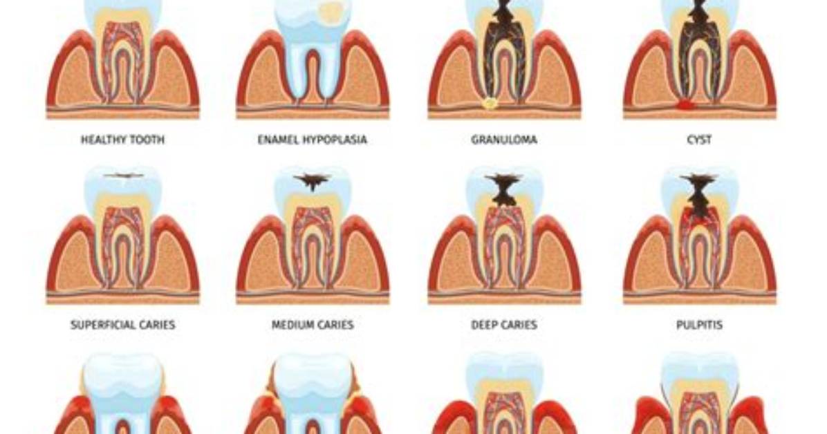 Is It a Cavity or Wisdom Tooth?
