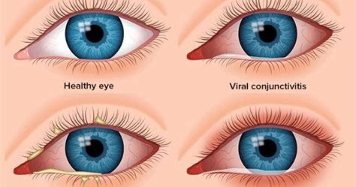 Is It Conjunctivitis or Something Else?