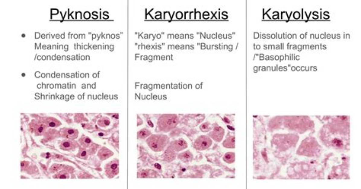 Is Karyorrhexis Reversible