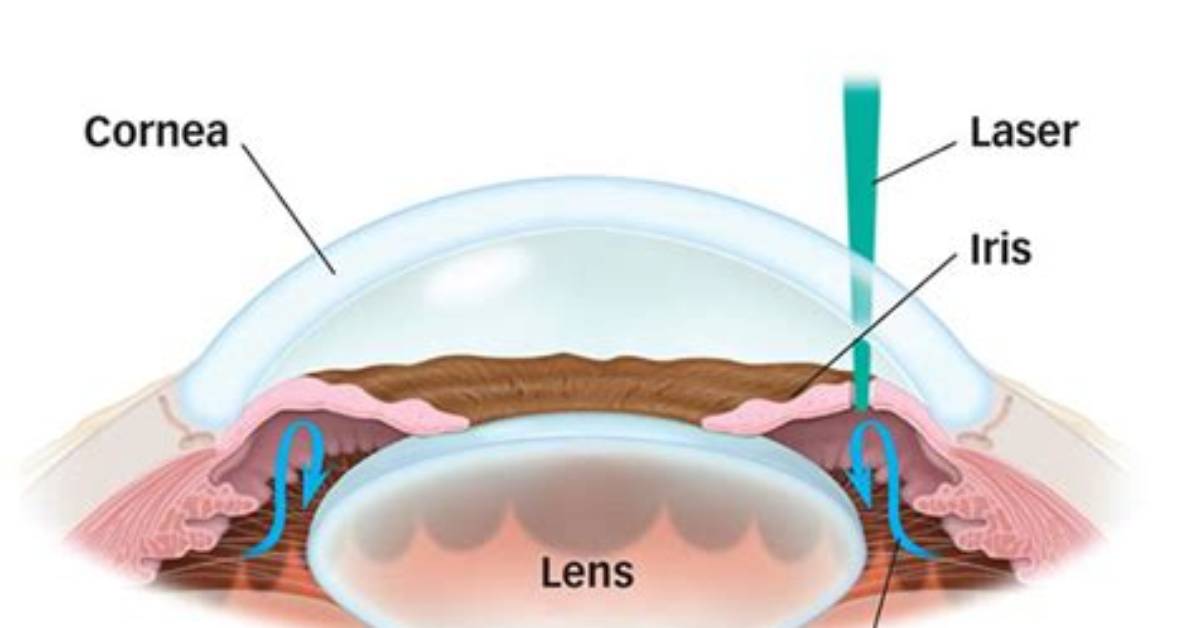 Is Laser Iridotomy Really Necessary