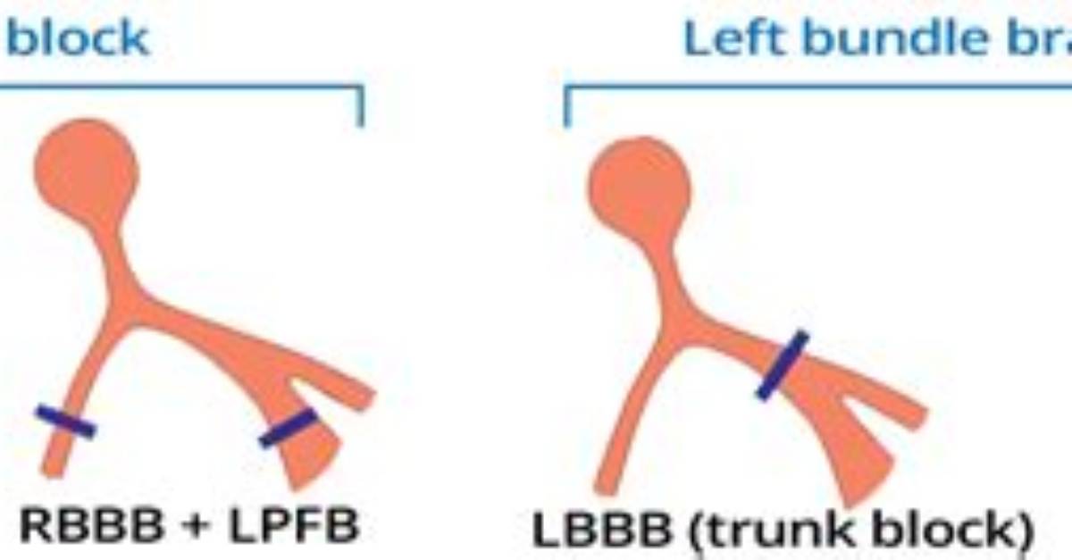 Is Lbbb Bifascicular Block